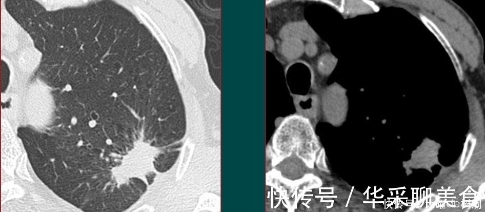 体检|年年体检,为什么还得了晚期肺癌?体检有啥用!