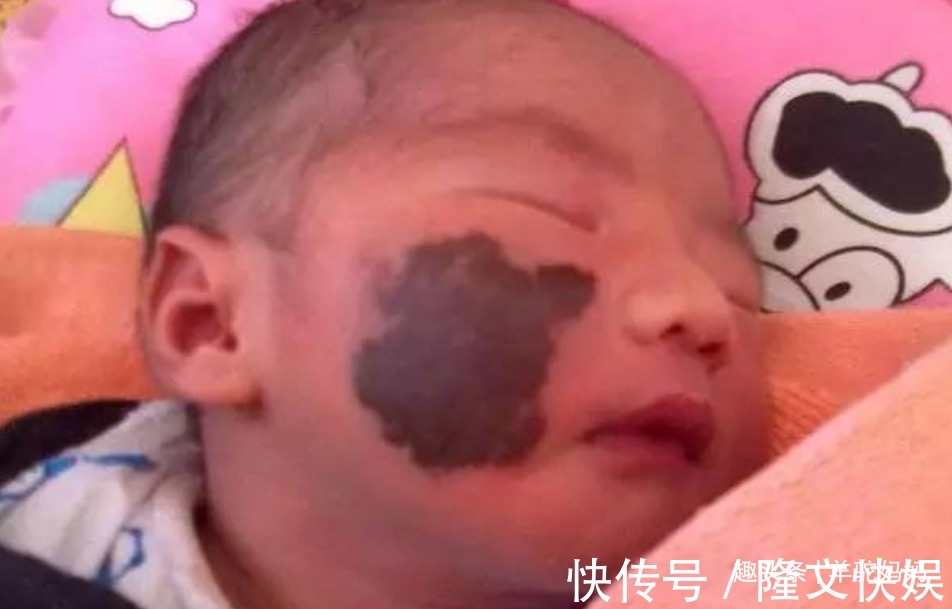血管瘤|越来越多胎儿被“胎记”缠身,若不想孩子自卑,孕妈要管住自己
