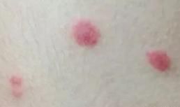 红包|宝宝身上有“红包”，就是被蚊子咬的？这种虫子更要小心