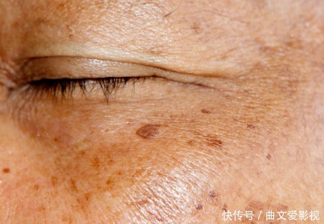 为什么年纪轻轻有老年斑?医生直言:常吃2物,远离老年斑!