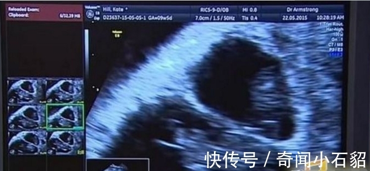 真相|女子与丈夫同房3个月内竟怀孕两次,得知真相后令人惊讶不已