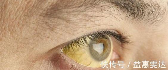 食物|身体两处“发痒”,别误以为过敏了,又可能是肝癌的征兆!