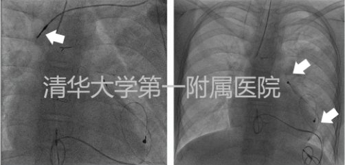 清华大学|11岁女孩心脏起搏器囊袋竟严重感染？看清华大学第一附属医院如何治疗！