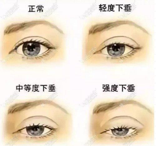下垂|上眼皮下垂做额肌瓣悬吊术改善能管几年?术后会出现闭不上眼的情况吗