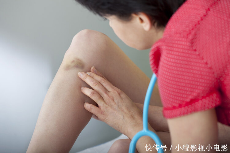 医院|身上无缘无故有淤青,很可能是肝不好!医生提醒:快去医院检查