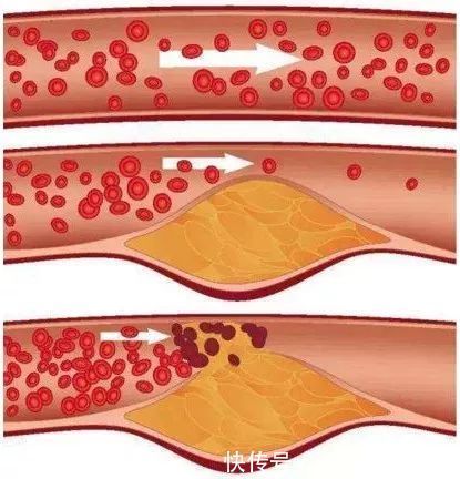 血管堵塞|88岁国医，血管光滑无斑块！他坚持30年的养生二宝，值得借鉴！