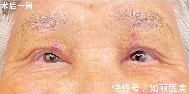 切口 双眼皮越宽眼睛就越大吗?医生揭开双眼皮手术的5个“真相”!