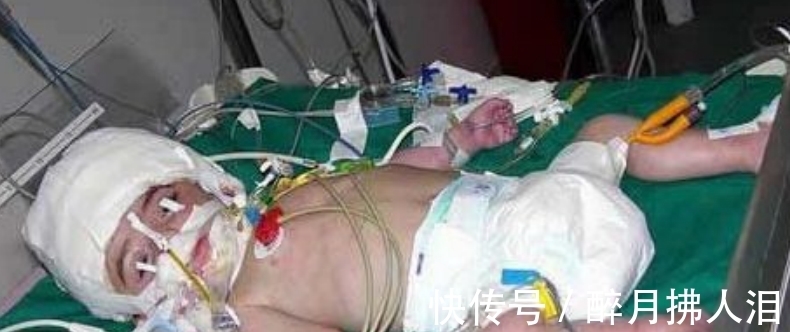 诺拉|小女孩从小有“双头”,进行割头手术