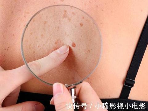 肝脏|实不相瞒!身体出现4个表现,或是肝硬化前兆,早治疗早好