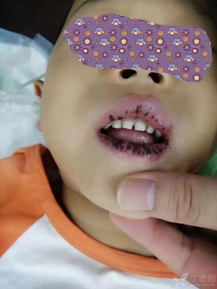 结肠|6岁孩童口唇满布黑斑,竟诊断为结肠多发息肉,你怎么看?