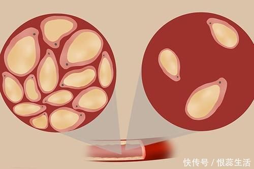 医生|血脂降到正常范围,他汀隔天服用,身体会怎么样?医生详解