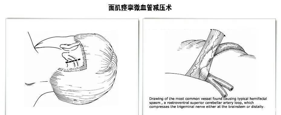 天敌|爱美人士的“天敌”：偏爱女性朋友的面肌痉挛