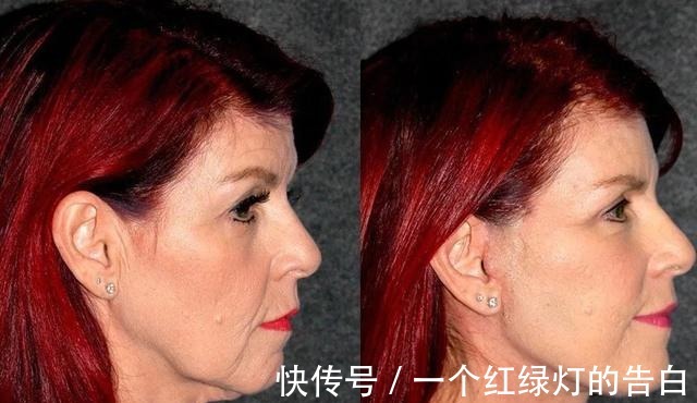 后遗症 拉皮手术“落伍”了,早都“过时”了!