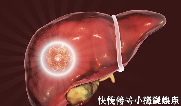 肝病|重视:除了皮肤小红点,身体出现4个异常,可能是肝硬化“敲门”