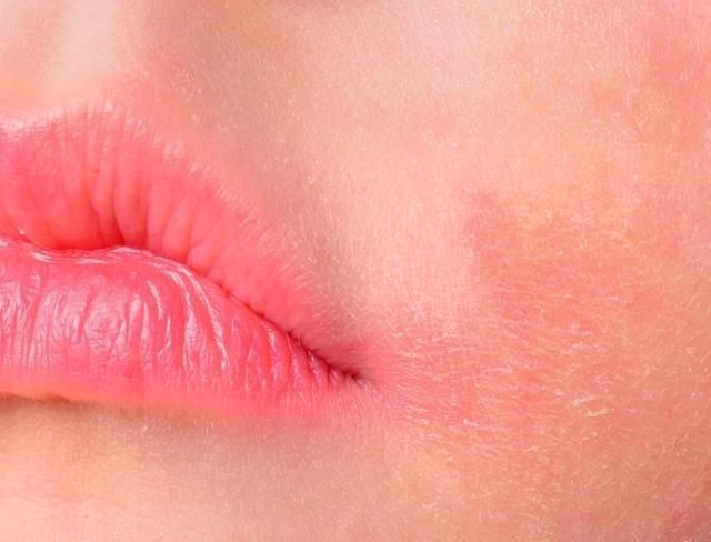 湿疹|宝宝湿疹的3个治疗误区，别再走“弯路”了！