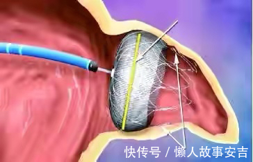 脑梗死|人到中年,如何避免脑梗死,做到三个坚决,让你生活更健康