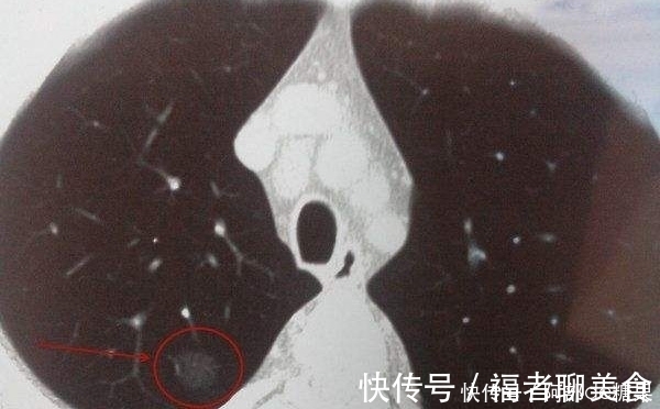 体检|肺部结节不一定是肺癌！4类结节，不是恶性，或不会癌变