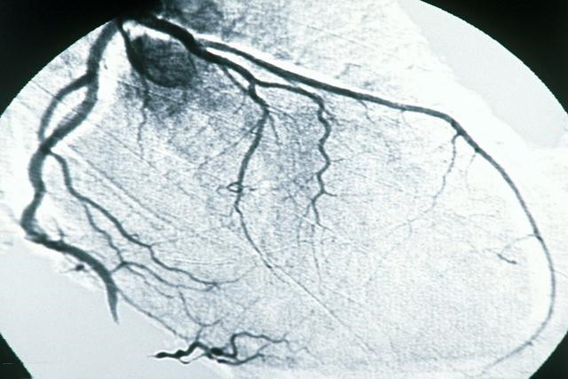 心绞痛|年轻时高血压不控制,如今52岁,发展为心脏病,还得放支架