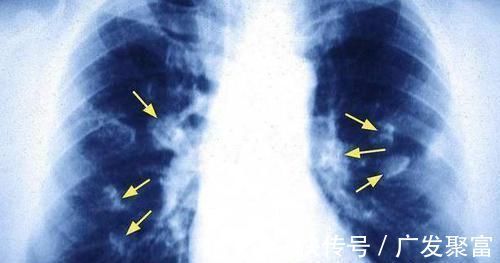 淋巴结|肺癌早期也是有迹可循的,身体出现这5个异常,还请及时就诊检查!