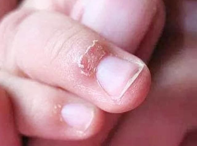 维生素|孩子的手总起倒刺,可能不是缺乏维生素,而是在提醒该做这件事了