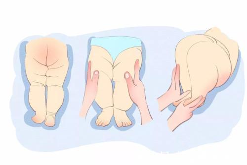 宝宝|宝宝腿纹不对称跟髋关节发育不良有什么关系,3种情况要注意