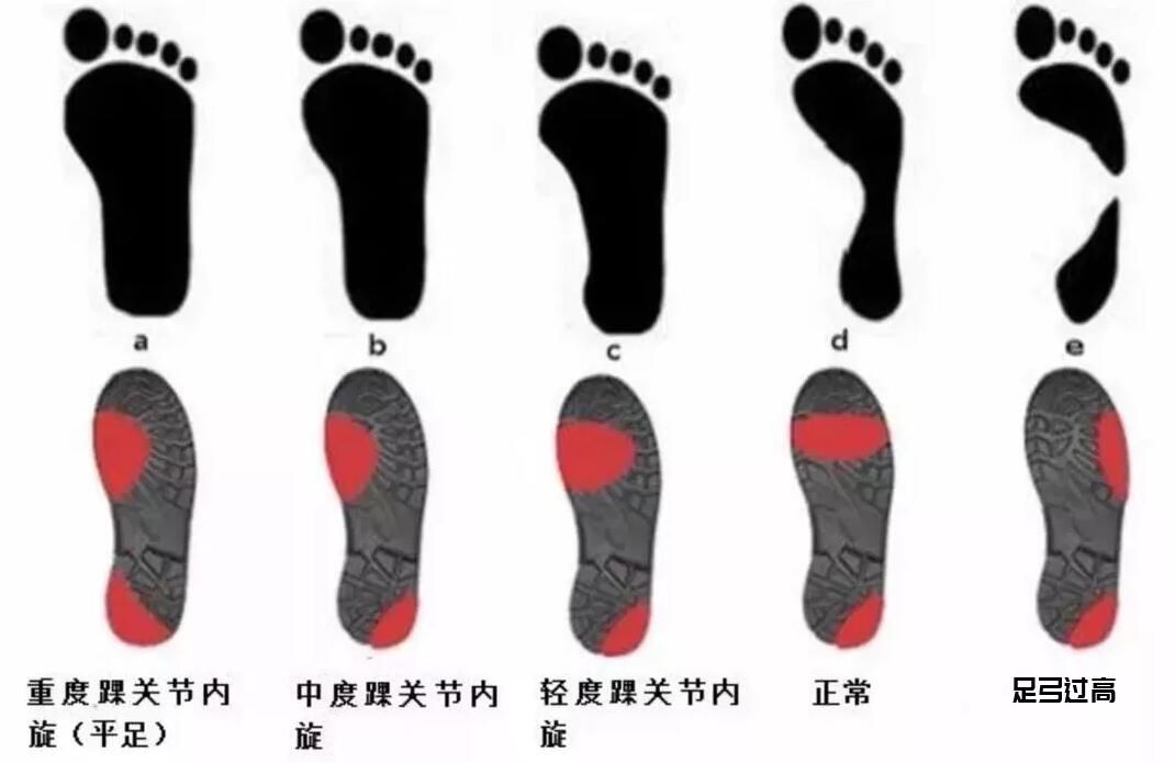 鞋底|足部变形的四个求救信号，需要多注意