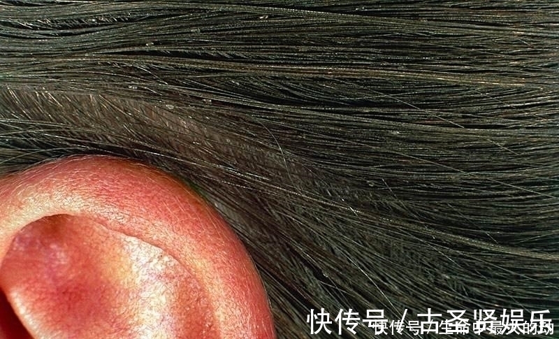 虱子|为什么头上会长虱子?真相原来如此,看完恍然大悟