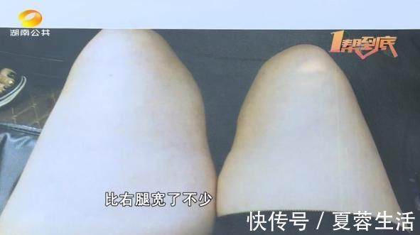 伍女士 抽脂手术致十级伤残,女子索赔百万遭拒绝?