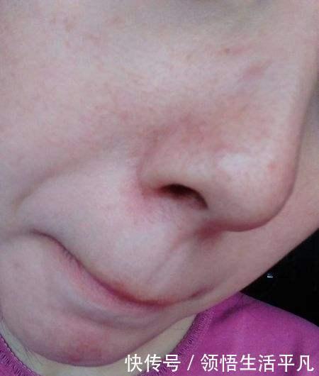 鼻子上挤出来的白色物体是什么皮肤科医生给出这些忠告