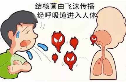 餐筷|转发：与肺结核患者分餐筷就可以避免被传染吗？