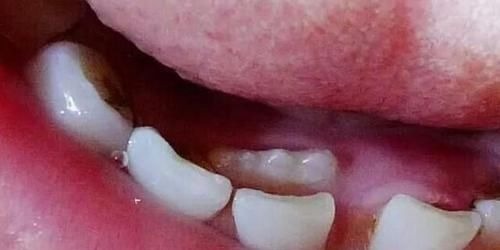 脱落|孩子“乳牙”脱落别着急扔,关键时刻能救命不懂为啥尽快了解下