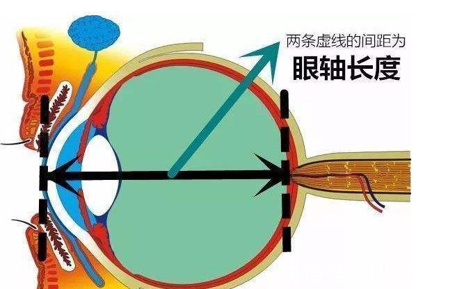 近视|科普|眼轴长度评估在近视防控中的重要作用!