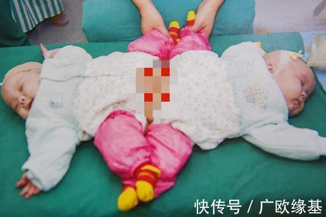 双胞胎|我国首例“坐骨连体”双胞胎,成功分开11年了,她们现在还好吗