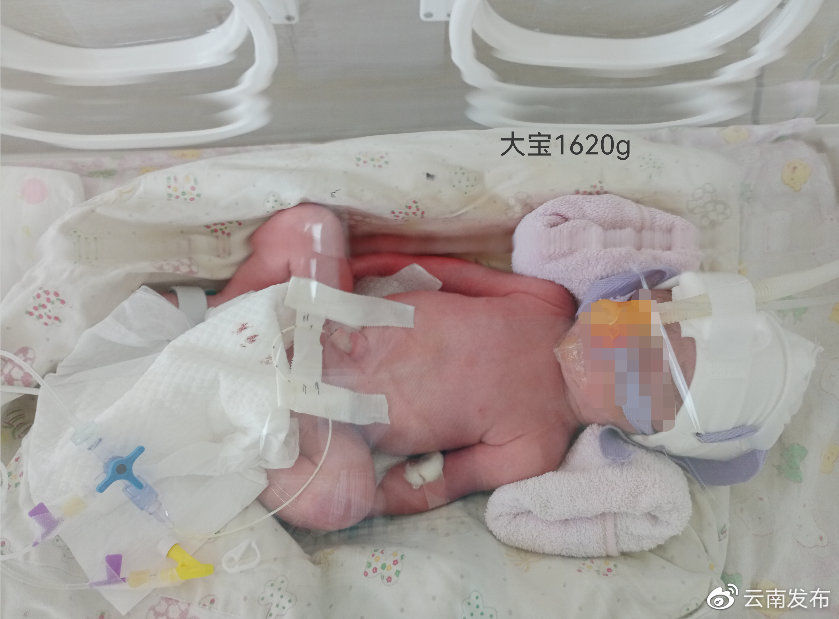 瑞丽|全国首例新冠肺炎确诊三胞胎孕妇在瑞丽顺利生产