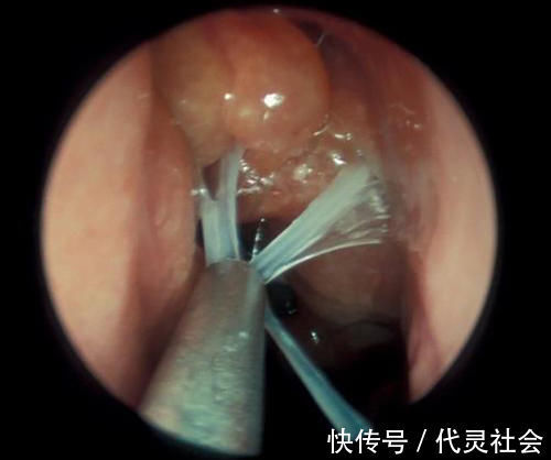 雾化|宝宝有痰咳不出怎么办?宝妈先别急,试试3个排痰方法,很管用