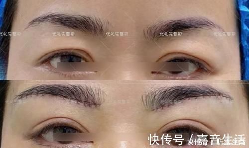 筋膜 提眉手术多久恢复自然?提眉手术可以维持多久?提眉手术疼吗?