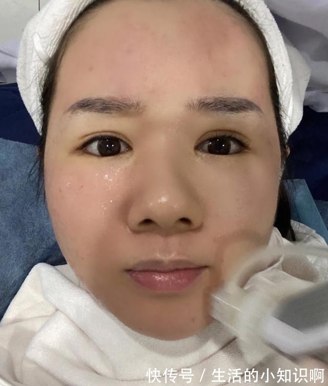 痤疮 做医美能把皮肤做好吗!