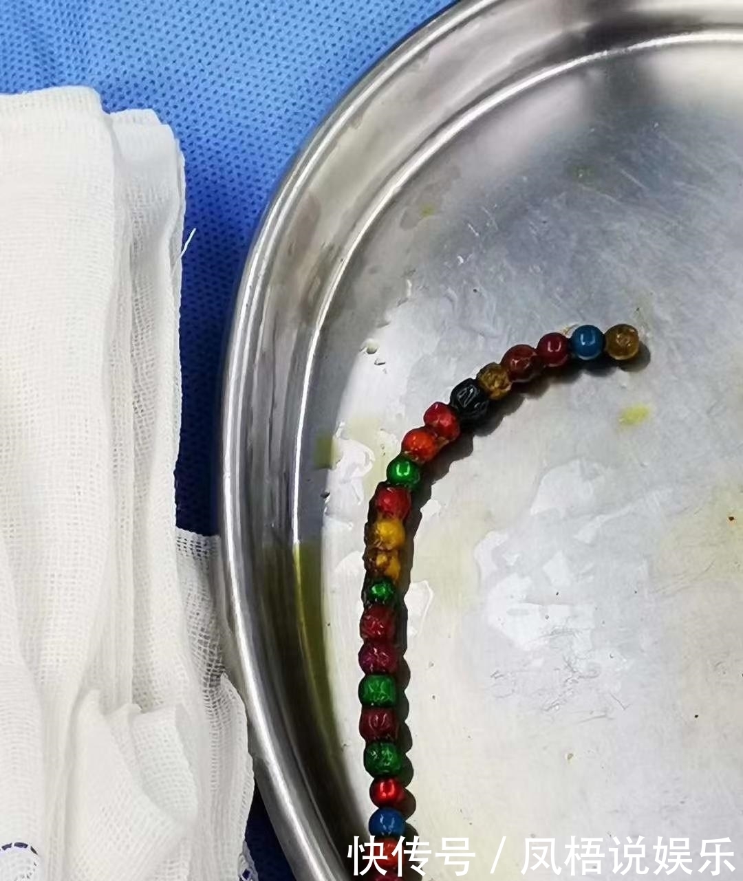 误食|3岁男童误食22颗巴克球，小肠8处穿孔 医生建议：14周岁以下别玩