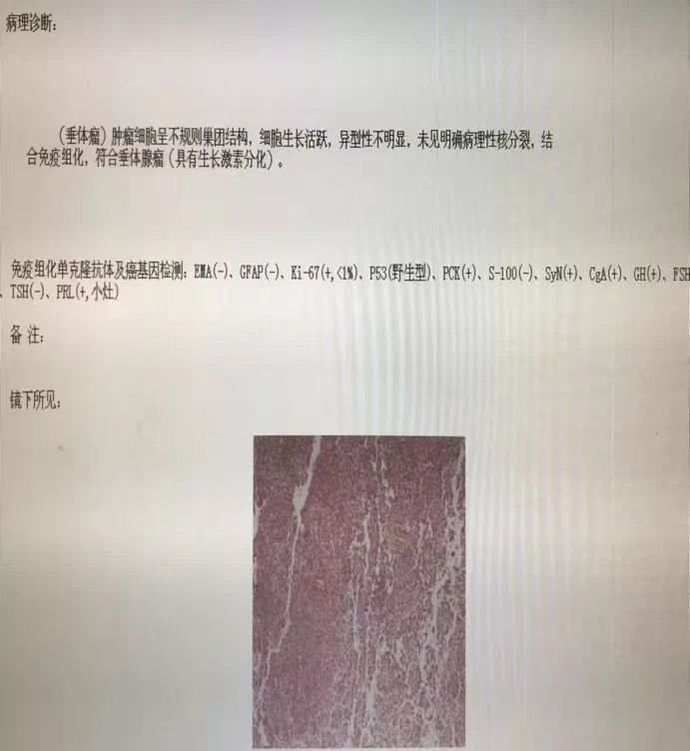 浙江省立同德医院|40多岁大姐外貌却像饱经风霜的老农， 原来是脑袋里长了肿瘤