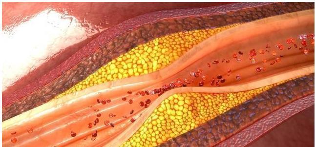 食物|一种食物是血栓的“死对头”,夏天多吃,血管干干净净,一通到底