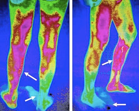 男子|男子修“鸡眼”烂了脚差点截肢!医生提醒:这类人要警惕