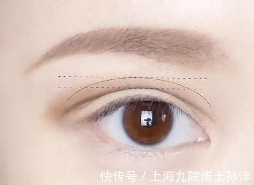祛疤 全切双眼皮术后需要使用消除伤疤的药吗,多久可以使用?