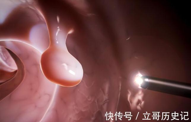 放射性直肠炎|患上直肠炎,身体会出现什么变化?这6个异常,都得多留个心眼