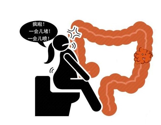 排便|这才是大肠癌的“早期信号”!等出现便血症状,或可能已经晚了