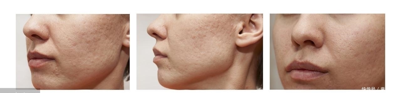 起床洗脸后没有这3个现象,说明脸上一只螨虫都没有,恭喜你