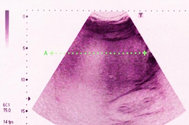 患者|肝癌的扩散速度有多快医生提醒三招预防让肝无忧