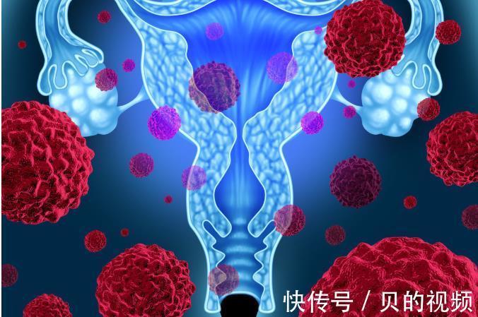 肿瘤病毒|这4个症状,超过3个宫颈癌已不是早期,做好1件事,宫颈癌走远远