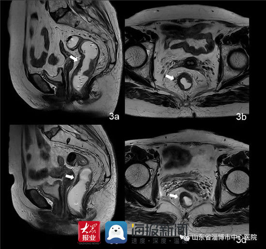 病变|淄博市中心医院放射科巧用耦合剂灌肠行高分辨率MRI精准诊断