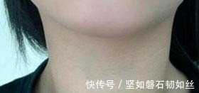 症状|感染艾滋只需0.1秒身体出现这3个症状,别拖到“并发症”发威