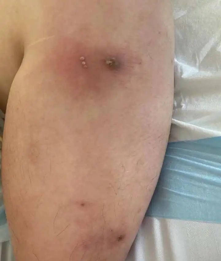 医生|被蚊子咬了一口,孕妈紧急剖宫产保命!1岁宝宝也中招!医生紧急提醒……